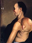 Portrait of a man with a large tumor